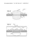 FILAMENTARY DEVICES FOR TREATMENT OF VASCULAR DEFECTS diagram and image