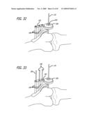 SURGICAL IMPLANTATION METHOD AND DEVICES FOR AN EXTRA-ARTICULAR MECHANICAL ENERGY ABSORBING APPARATUS diagram and image
