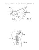 SURGICAL IMPLANTATION METHOD AND DEVICES FOR AN EXTRA-ARTICULAR MECHANICAL ENERGY ABSORBING APPARATUS diagram and image