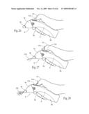 Irrigation and aspiration devices and methods diagram and image