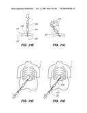 DEVICES, SYSTEM AND METHODS FOR MINIMALLY INVASIVE ABDOMINAL SURGICAL PROCEDURES diagram and image