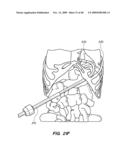 DEVICES, SYSTEM AND METHODS FOR MINIMALLY INVASIVE ABDOMINAL SURGICAL PROCEDURES diagram and image