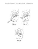 DEVICES, SYSTEM AND METHODS FOR MINIMALLY INVASIVE ABDOMINAL SURGICAL PROCEDURES diagram and image