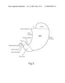 Laparoscopic Gastric and Intestinal Trocar diagram and image