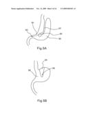 Laparoscopic Gastric and Intestinal Trocar diagram and image