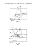 Laparoscopic Gastric and Intestinal Trocar diagram and image