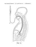 ANASTOMOSIS PATCH diagram and image