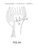 Method and device for securing sutures to bones diagram and image