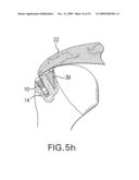 Method and device for securing sutures to bones diagram and image