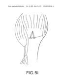 Method and device for securing sutures to bones diagram and image