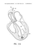 PERIPHERAL SEAL FOR A VENTRICULAR PARTITIONING DEVICE diagram and image