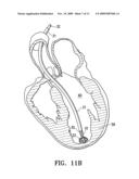 PERIPHERAL SEAL FOR A VENTRICULAR PARTITIONING DEVICE diagram and image