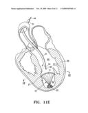 PERIPHERAL SEAL FOR A VENTRICULAR PARTITIONING DEVICE diagram and image