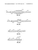 SYSTEMS AND METHODS FOR STONE REMOVAL diagram and image