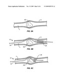 SYSTEMS AND METHODS FOR STONE REMOVAL diagram and image