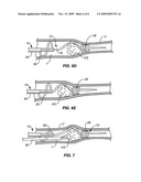 SYSTEMS AND METHODS FOR STONE REMOVAL diagram and image