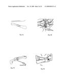 Implant for long bones and treatment method diagram and image
