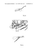 Implant for long bones and treatment method diagram and image