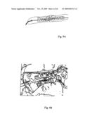 Implant for long bones and treatment method diagram and image