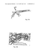 Implant for long bones and treatment method diagram and image