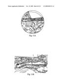 Implant for long bones and treatment method diagram and image