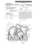 Medical Device for Constricting Tissue or a Bodily Orifice, for example a mitral valve diagram and image