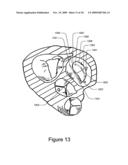 Medical Device for Constricting Tissue or a Bodily Orifice, for example a mitral valve diagram and image