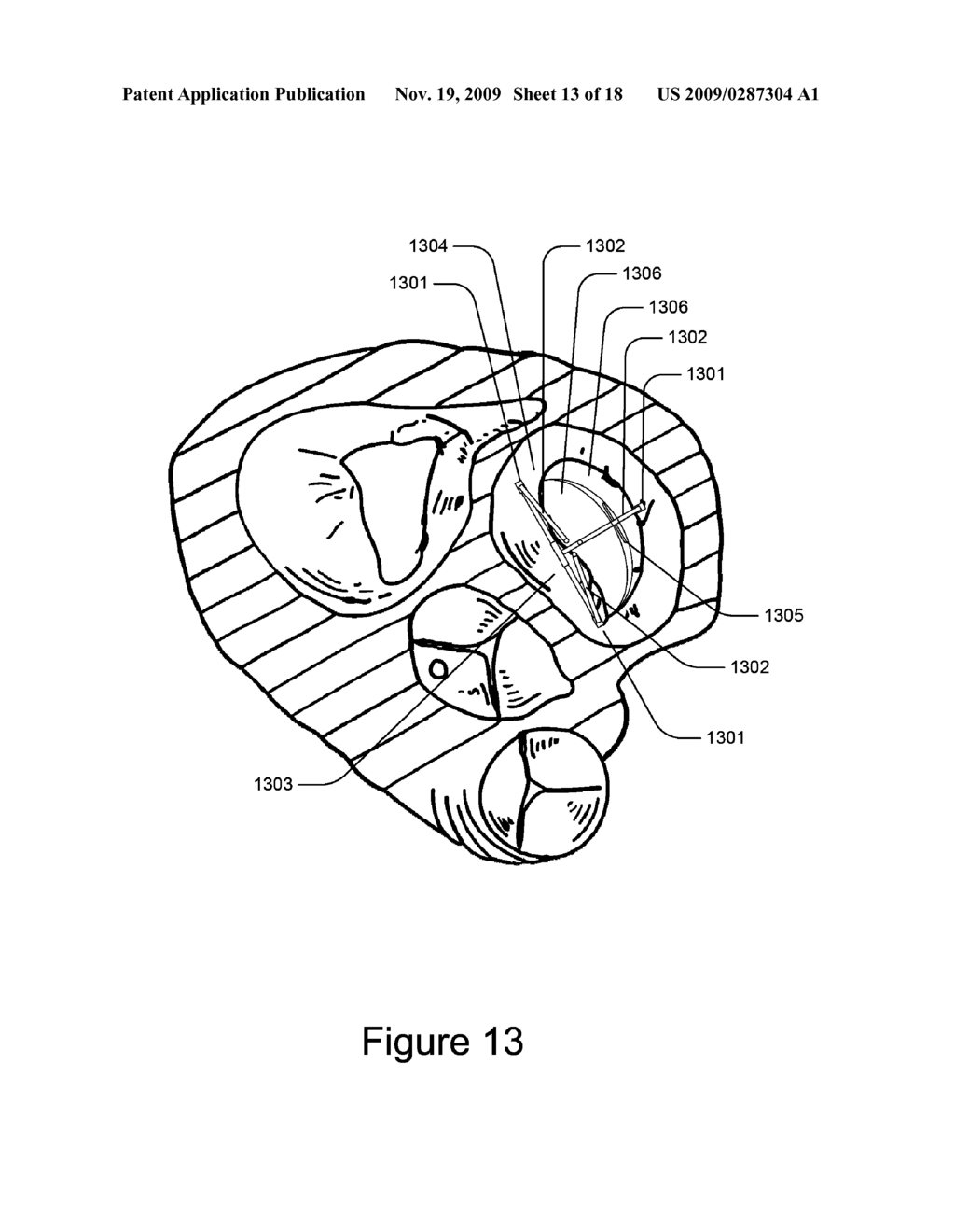 Medical Device for Constricting Tissue or a Bodily Orifice, for example a mitral valve - diagram, schematic, and image 14