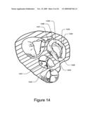 Medical Device for Constricting Tissue or a Bodily Orifice, for example a mitral valve diagram and image