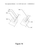 Medical Device for Constricting Tissue or a Bodily Orifice, for example a mitral valve diagram and image