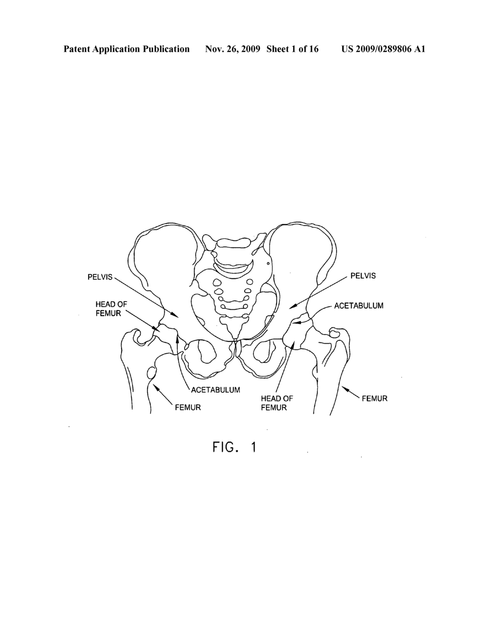 COMPUTER-GUIDED SYSTEM FOR ORIENTING THE ACETABULAR CUP IN THE PELVIS DURING TOTAL HIP REPLACEMENT SURGERY - diagram, schematic, and image 02