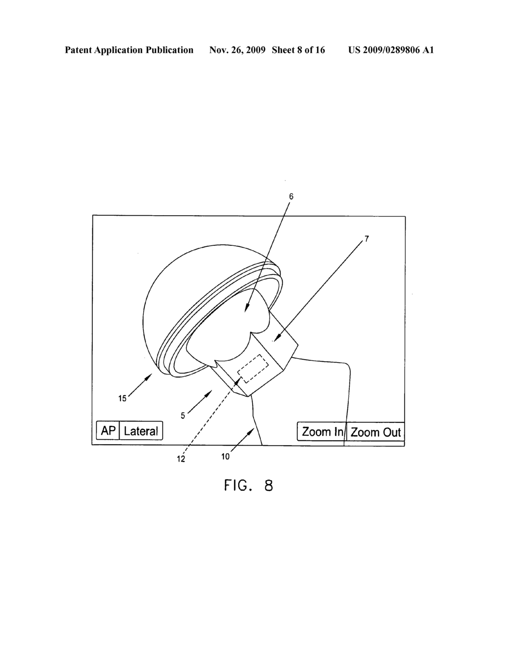 COMPUTER-GUIDED SYSTEM FOR ORIENTING THE ACETABULAR CUP IN THE PELVIS DURING TOTAL HIP REPLACEMENT SURGERY - diagram, schematic, and image 09