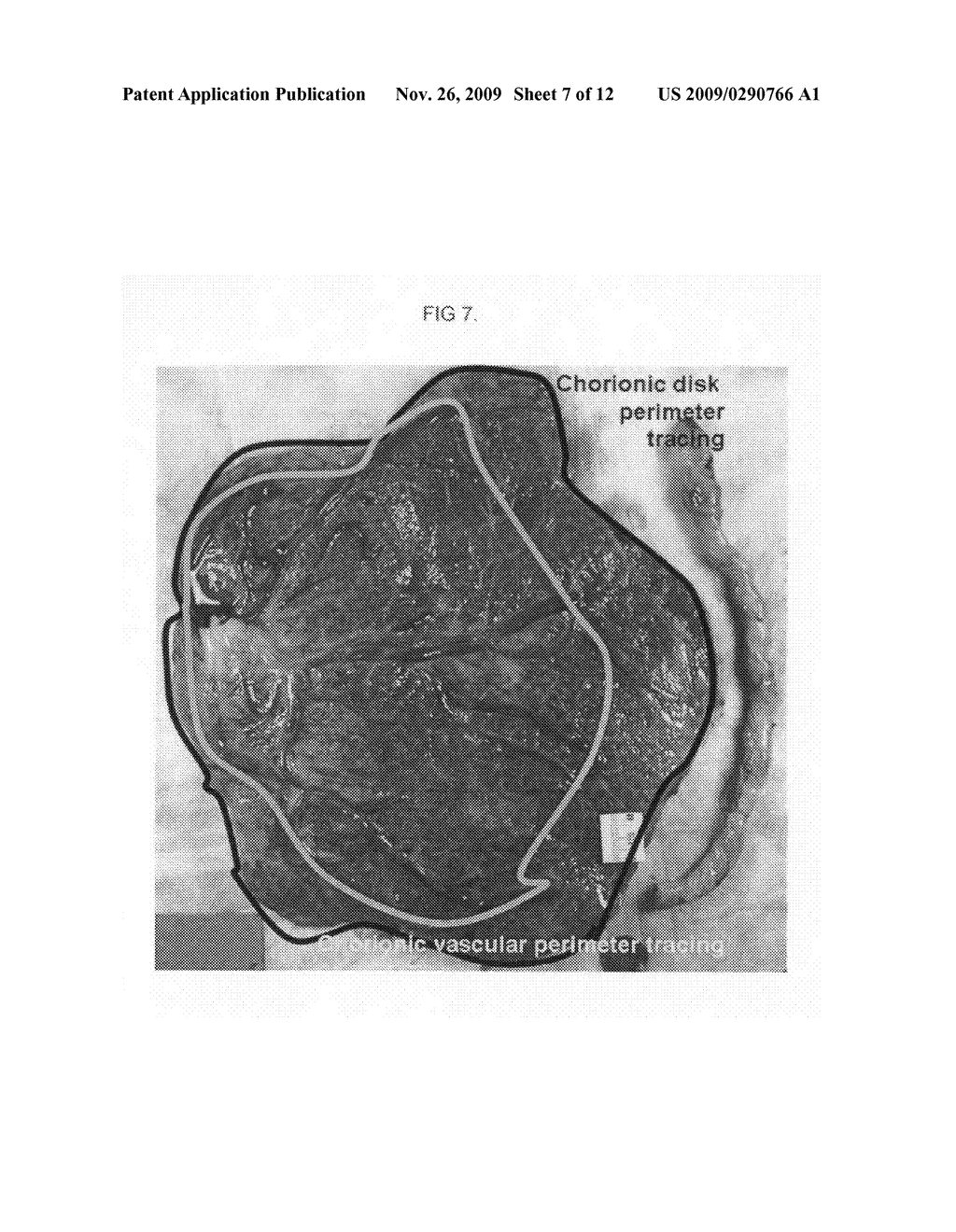 Automated placental measurement - diagram, schematic, and image 08