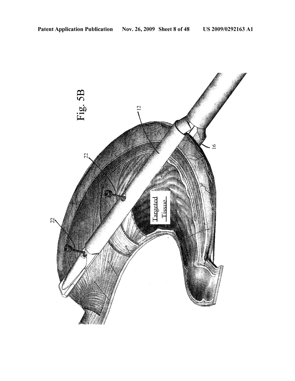 DEVICES AND METHODS FOR ACHIEVING THE LAPAROSCOPIC DELIVERY OF A DEVICE - diagram, schematic, and image 09