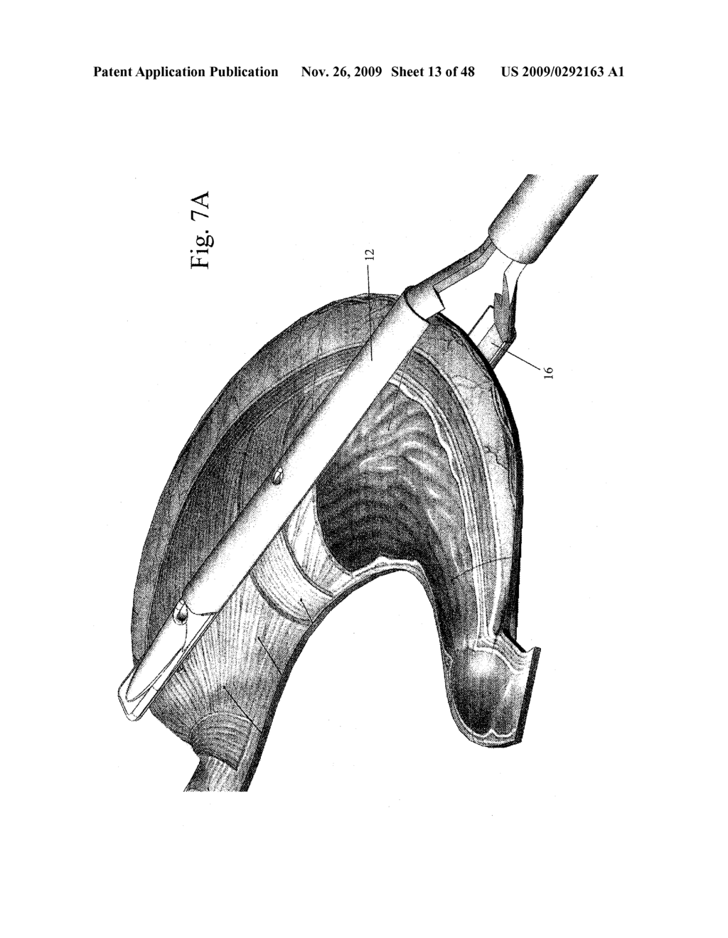 DEVICES AND METHODS FOR ACHIEVING THE LAPAROSCOPIC DELIVERY OF A DEVICE - diagram, schematic, and image 14