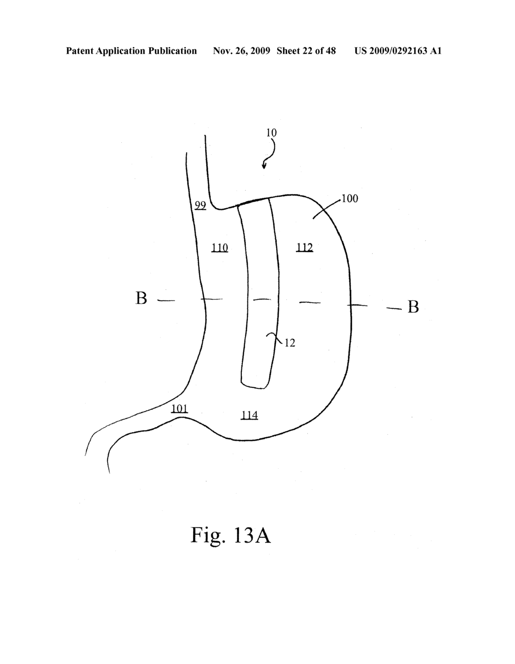 DEVICES AND METHODS FOR ACHIEVING THE LAPAROSCOPIC DELIVERY OF A DEVICE - diagram, schematic, and image 23