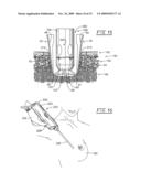 Method and apparatus for positioning a tissue recovery instrument in confronting adjacency with a target tissue volume diagram and image