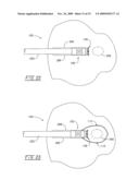 Method and apparatus for positioning a tissue recovery instrument in confronting adjacency with a target tissue volume diagram and image