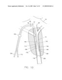 Method for Inserting a Catheter diagram and image