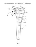 GUIDE ASSEMBLY FOR INTRAMEDULLARY FIXATION AND METHOD OF USING THE SAME diagram and image