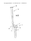 GUIDE ASSEMBLY FOR INTRAMEDULLARY FIXATION AND METHOD OF USING THE SAME diagram and image