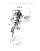 ELECTRICAL STIMULATION TREATMENT OF HYPOTENSION diagram and image