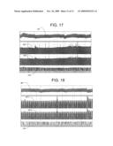 ELECTRICAL STIMULATION TREATMENT OF HYPOTENSION diagram and image