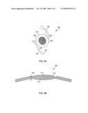 REDUCED PROFILE INTRAOCULAR LENS diagram and image