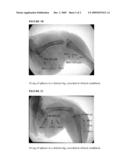 HOMOGENEOUS, INTRINSIC RADIOPAQUE EMBOLIC PARTICLES diagram and image