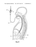 ELECTRICAL ABLATION DEVICE diagram and image