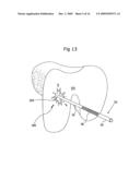 Surgical bone cutting assembly and method of using same diagram and image