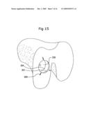 Surgical bone cutting assembly and method of using same diagram and image