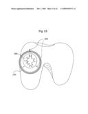 Surgical bone cutting assembly and method of using same diagram and image