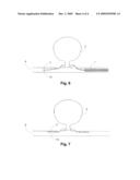 DEVICE AND METHODS FOR NON-SURGICAL CLIPPING OF ANEURYSMS diagram and image